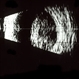 Choroidal melanoma; B-scan Choroidal melanoma; B-scan